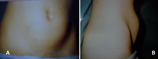 Figure 1: Abdominal mass of the left hypochondrium extended to the hypogastrium in front view (a) and in profile (b).