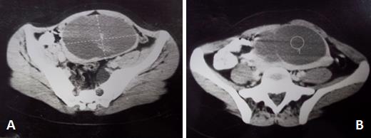 Figure 2: Abdominal-pelvic CT without injection in axial section showing the well-limited and homogeneous splenic tumor (a) and specifying its fluid content (b).