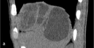 Figure 3: CT abdominal with three-dimensional reconstruction: splenic hydatid cystic type 3 of Gharbi (multivesicular) associated with a hepatic HC (b).