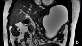 Figure 5: Macroscopic appearance of the splenic hydatid cyst intraoperatively.