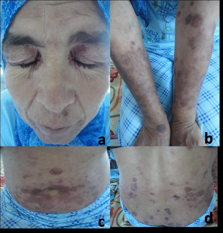 Figure 1: Multiple pruritic, erythematous and hyperpigmented patches, 1-3 cm in diameter with some blisters and erosions on the (a) face, (b) Forearm, (c) Abdomen and (d) back.