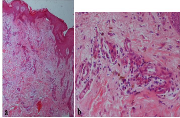 Figure 2: Vacuolar interface dermatitis with necrotic keratinocytes and a predominantly lymphohistiocytic inflammatory infiltrate with neutrophils and eosinophils; (a) H and E X 40 and (b) Hand E X 200. Based on the clinical and histopathologic findings, a diagnosis of multifocal FDE due to mefenamic acid was made. Patch tests performed with Mefaminic Acid 30% in petrolatum applied directly to healthy and lesional skin were positive (Figure 3). The patient was advised to stop taking mefenamic acid and since that, there have been no further episodes of inflammation after a mean follow-up of 1 year.