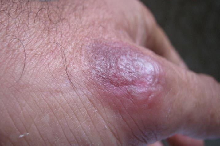 Figure 3: Positive reaction of patch test performed with Mefaminic acid 30% in petrolatum. Discussion Fixed drug eruption was first described by Bourns [1] in 1889. It is defined by the appearance of lesions at always the identical location after repeated exposure to the responsible drug [2]. It represents a IVc type drug- induced reaction of the skin and mucous membranes [3].