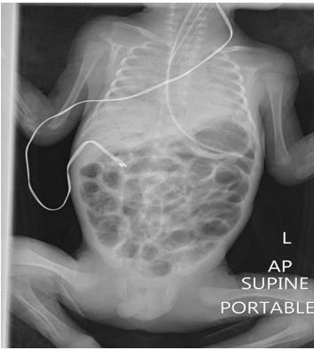 Figure 1: Abdomen x-ray (AP view) showing pneumatosis intestinalis and air in portal vein.