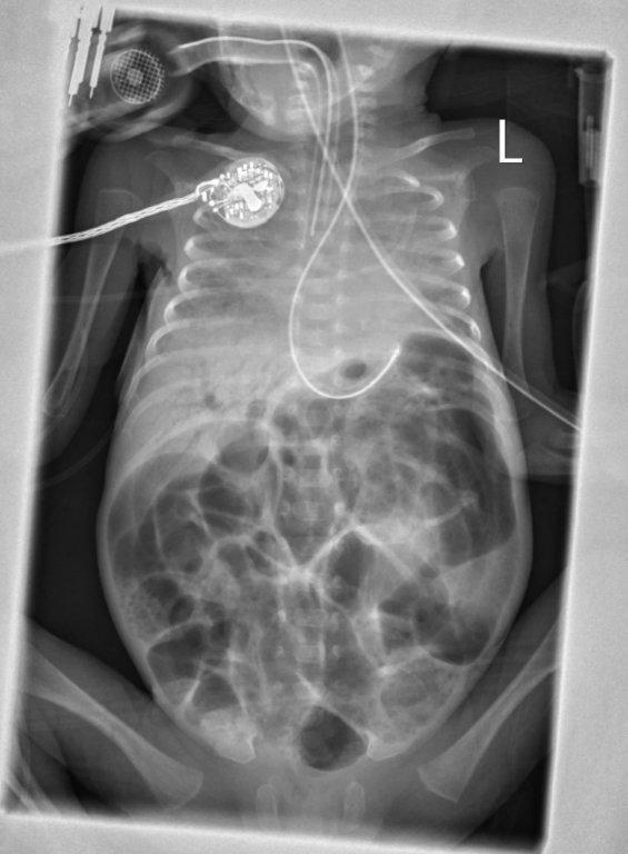 Figure 4: Abdomen x-ray (AP view) showed generalized abdominal distension with air in portal vein.