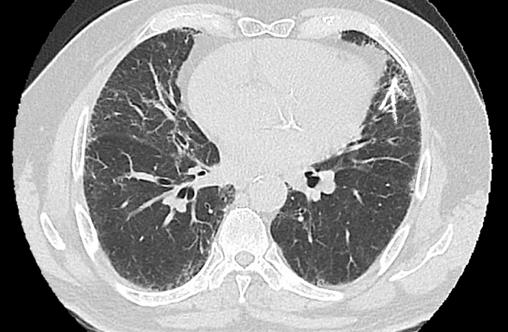 Figure 4: Axial reconstruction with areas of consolidation in the middle lobe (curved arrow).