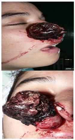 Figure 2: Patient, 23, pregnant with enormous angiofibrome SA 27 of the partition externalized by the right nasal vestibule.