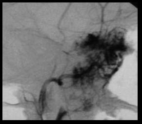 Figure 3: Endoscopic appearance of a cavernous hemangioma in a man of 45 years.