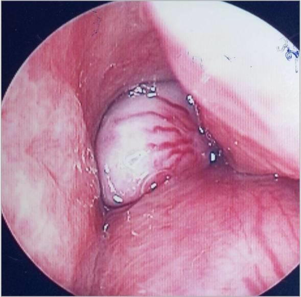 Figure 4: Left: CT nasosunisienne: NPF centered on IFN right fusing through the choanal opening to the nasopharynx is filled; Right: CT of the face: angiofibroma of the right nasal septum embellished injection PDC.