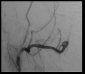 Figure 5: Left: Angiography of NPF: opacification of the external carotid: vascular blush fed by branches of the internal maxillary artery; Right: Unofficial blusch after embolization.