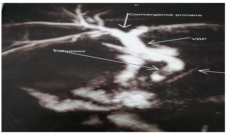 Figure 1: Magnetic resonant cholangiopancreatograph y showing the lithiasis of common bile duct and the absence of the gallbladder.