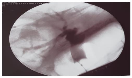 Figure 2: Images endoscopic retrogradeCholangio- Pancreatography showing the lithiasis of common bile duct and the absence of gallbladder.
