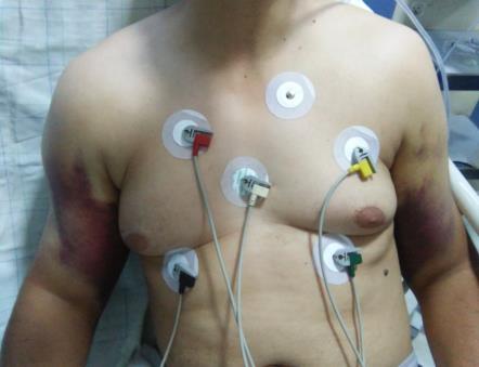 Figure 1: Photo of the traumatized patient with bilateral shoulder deformity and presence of bruises on both arms.