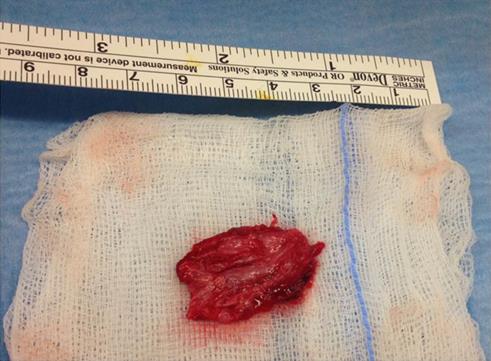 Figure 1: Deep fascia graft.