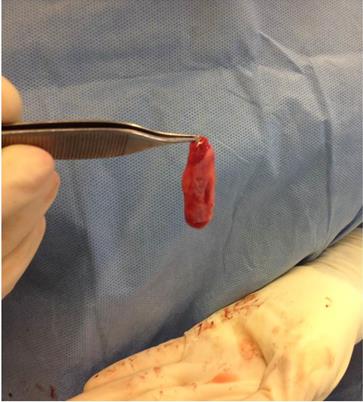 Figure 11: The chrysalis graft is inserted into the nasal dorsum.