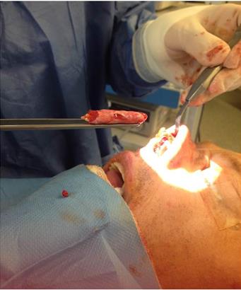 Figure 12: Case 5 of the table. Female, 38 years old, preoperative and 11 months postoperative frontal views.
