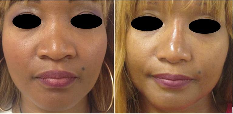Figure 13: Case 5 of the table. Female, 38 years old, preoperative and 11 months postoperative lateral views.