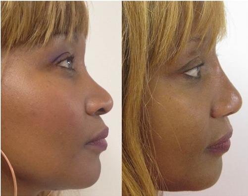 Figure 14: Case 4 of the table. Male, 61 years old, preoperative and 13 month’s postoperative frontal views.