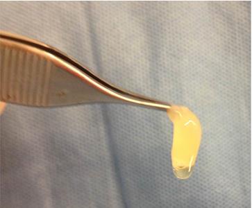 Figure 2: Platelet Rich Plasma clot.