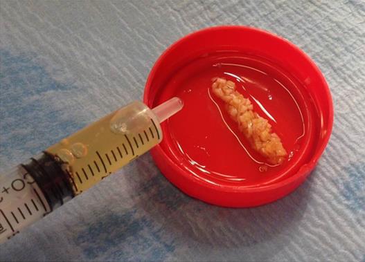 Figure 3: The diced cartilage is carried in the PRP clot and sprayed with the PPP acting as fibrin glue.