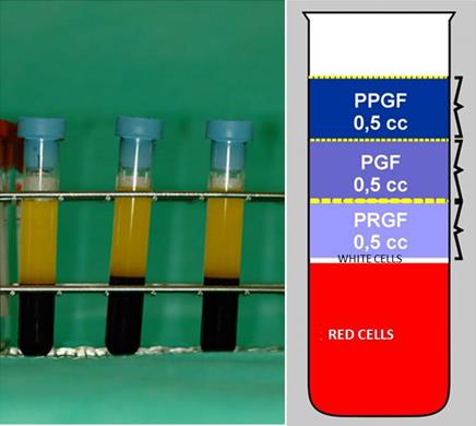 Figure 5: The blood tube after centrifugation shows 3 layers: the lower red layer containing red cells, the middle thin layer containing white cells, and the upper yellow layer containing platelets. The upper layer containing platelets can also be separated in 3 layers: the upper layer is the layer that contains less platelet growth factors and is called Plasma Poor in Growth Factors or Platelet-Poor Plasma (PPGF or PPP); the middle layer presents a very similar platelet proportion of peripheral blood (Plasma with Growth Factors, PGF); and the lower layer located immediately above the white series is the fraction corresponding to the major platelet concentration, it is called Plasma Rich in Growth factors or Platelet-Rich Plasma (PRGF or PRP).
