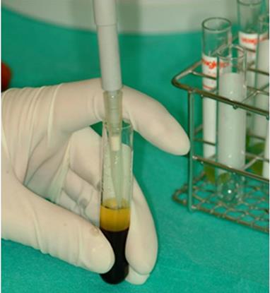 Figure 6: The upper (PPP) and middle platelet layers were extracted with sterile pipette to be used later as fibrin glue. The PRP fraction was extracted by manual pipetting and is the one used to carry the diced cartilage graft.