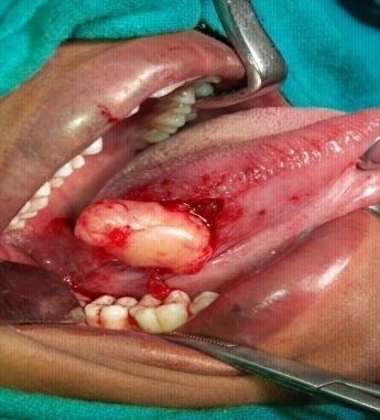 Figure 2: Intraoperative picture of peroral excision of the tumour showing the shiny and encapsulated surface.
