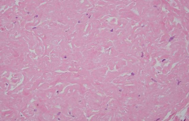 Figure 3: Histopathology of schwannoma, showing eosinophilic cords and compact oviod bodies (verocay bodies) with palisading. Discussion Schwannoma is a slow growing benign tumor arising from the schwann cells of nerve sheath. Approximately 25-45% of all schwannomas occur in the head and neck region [4]. An intraoral site israre, constituting only about 1% [7]. The peak incidence of Schwannoma is between the third and sixth decades of life, with no predilection for sex or race [10]. In our case it was young male of 17 years of age only. Although the tongue is the most common site of intraoral schwannoma there are, only 44 cases of schwannoma of tongue reported in the English literature in the last 20 years [17]. Clinically, schwannomas may be indistinguishable from other encapsulated benign tumors, like lipoma, haemengioma, fibroma, lingual thyroid, benign salivary gland tumors, rhabdomyoma, leiomyoma and lymphangioma, so biopsy and histological examination are essential for correct diagnosis.
