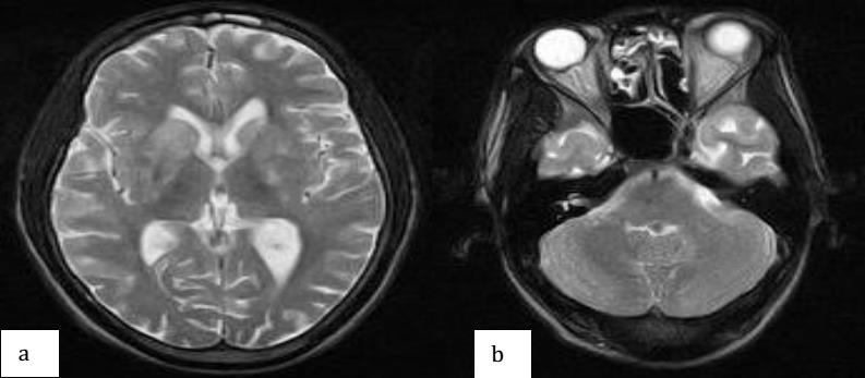 Figure 1: Axial section of brain MRI with gadolinium injection in T2-weighted sequence showing multiple hyper signals affecting gray matter (a) and right optic nerve (b).