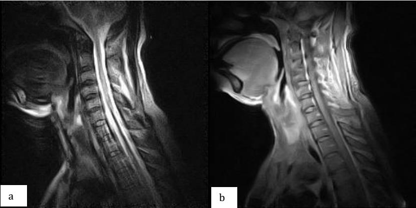 Figure 2: Sagittal section of cervical medullary MRI with gadolinium injection in FLAIR (a) and T2-weighted (b) sequences showing extensive intramedullary hypersignal.