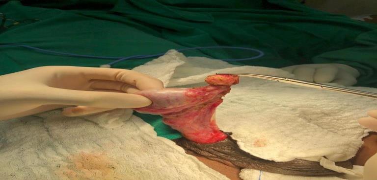 Figure 2: The structure is separate from the testicle.