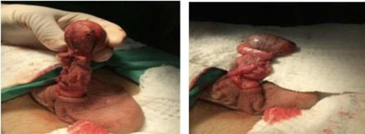 Figure 3: Epididymectomy with preservation of the testis and spermatic pathway.