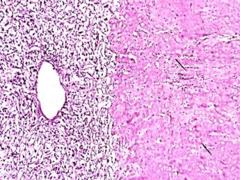Figure 10: RA, DM, pancreas, severe atherosclerosis involving small arteries (a) HE, x 50, (b) same as (a) x125