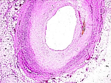 Figure 2: RA, heart, main (medium size) coronary artery Subacute-subchronic vasculitis with incipient (early stage) rheumatoid nodule in media and adventicia, sectorial accentuated leuco-lympho-plasmocellular infiltration and moderate fibromuscular intimal proliferation. (a) HE, x20 (b) same as (a) x50