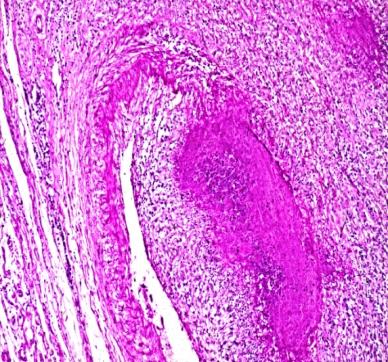 Figure 5: RA, adrenal gland and periadrenal fat tissue, late stage of systemic secondary AA amyloidosis Amyloid A deposited within the reticular, fascicular and glomerular zones of adrenal cortex, involving periadrenal blood vessels, reticular and collagen fibers (a) HE, x 50, (b) same as (a) x125, (c) same as Figure (a) Congo red staining viewed under polarized light, x50, (d) same as Figure (b and c) Congo red staining viewed under polarized light, x125