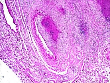Figure 6: RA, miliary disseminated caseous tuberculosis in the lung (a) HE, x 50, (b) same as (a) x125