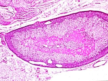 Figure 8: RA, lung, undifferentiated bronchoalveolar carcinoma Irregular spaces separated by fibrotic septa, and enveloped by tall partly columnar epithelium (a) HE, x 40, (b) same as (a) x100, (c) Anti-human epithelial membrane antigen (mono/DAKO N1504), x 100 (d) same as (c) x200