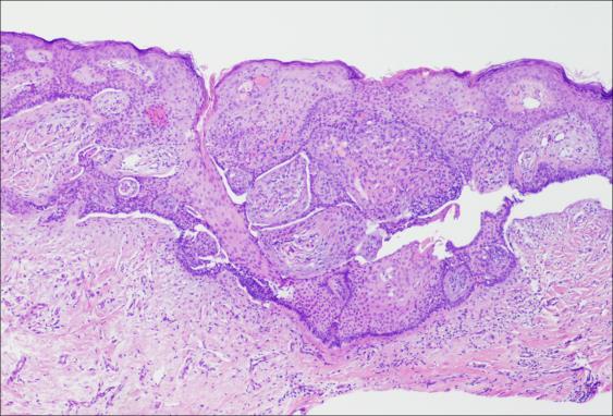 Figure 2: Trichoblastoma with Atrophic Epithelium and Basaloid Cell Clusters [19].