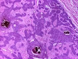 Figure 4: Trichoblastoma with a Predominant Cribriform Pattern and Fibrillary, Collagenous Stroma [20].