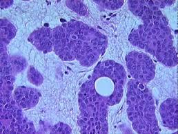 Figure 6: Pigmented Trichoblastoma with Basaloid Cells, Thin Epithelium and Fibroblastic Stroma [22].