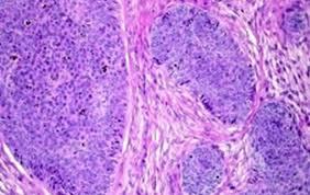 Figure 8: Trichoblastoma with Peripheral Palisade of Basaloid Nests and Fibrocellular Stroma [23].