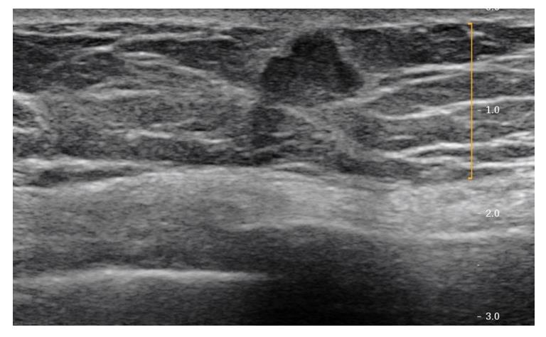 Figure 4: Grayscale ultrasound image of the left breast demonstrates a subareolar taller than wide irregular hypoechoic mass with lobular margins.