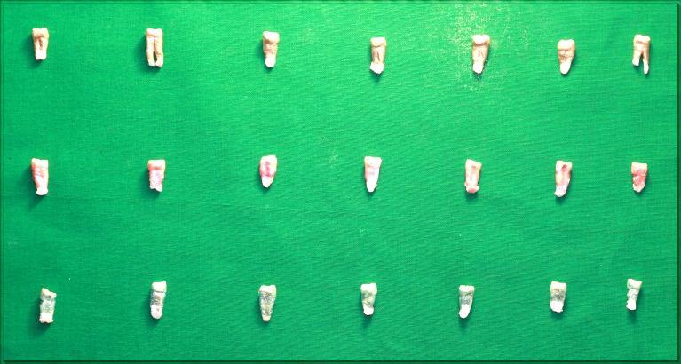Figure 3: Class I Cavity.