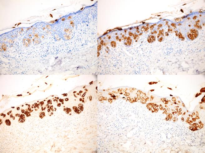 Figure 3: Immunohistochemical staining of the lesion a. CEA (+), b. CK7 (+), c. EMA(+), d. cerb-B2(+)(x200).