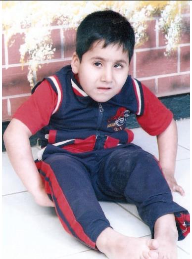 Figure 1: A boy with spastic cerebral palsy who remained unable to stand or walk at the age of six years with the development of flexion deformities.