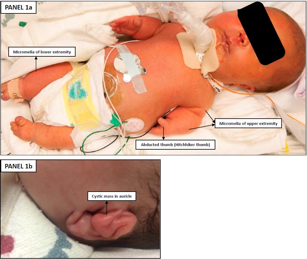 Figure 1: An abnormal spine and thickening from the neck down raising suspicion for dwarfism.