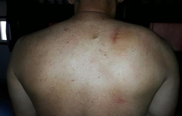 Figure 1: Right scapular mass.