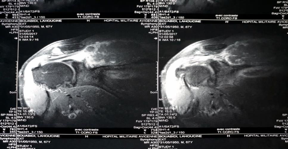 Figure 2: Magnetic resonance imaging (MRI) of the scapular region showed malignant tumor process.