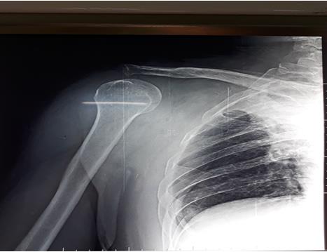Figure 4: X-ray of the right shoulder in postoperative.