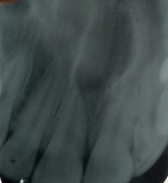 Figure 2: IOPA showing a heart shaped radiolucency between the central incisors.